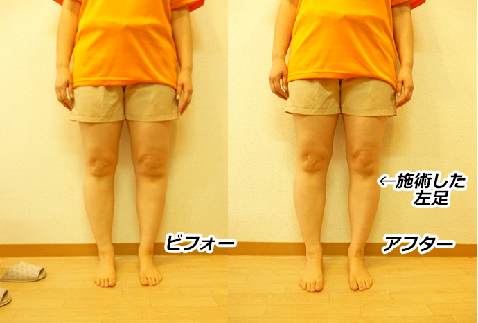 モニターのEさんに“左足のみ”の施術を受けてもらいました